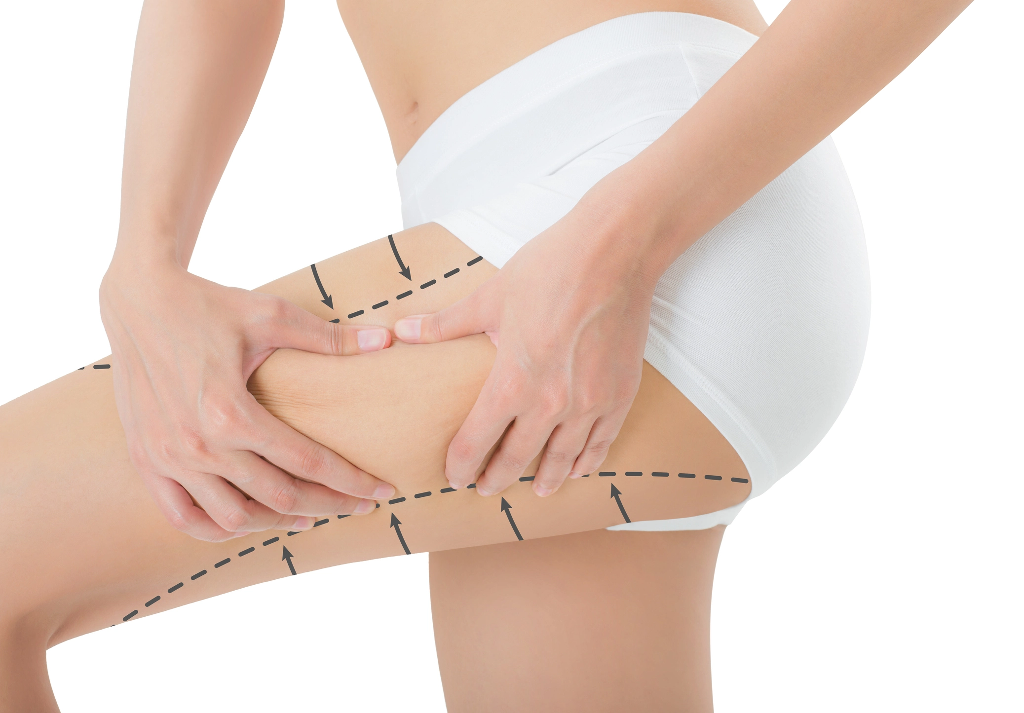 outer-thigh-fat-removal-aftercare-body-cosmetics-marlow-face-body-treatments
